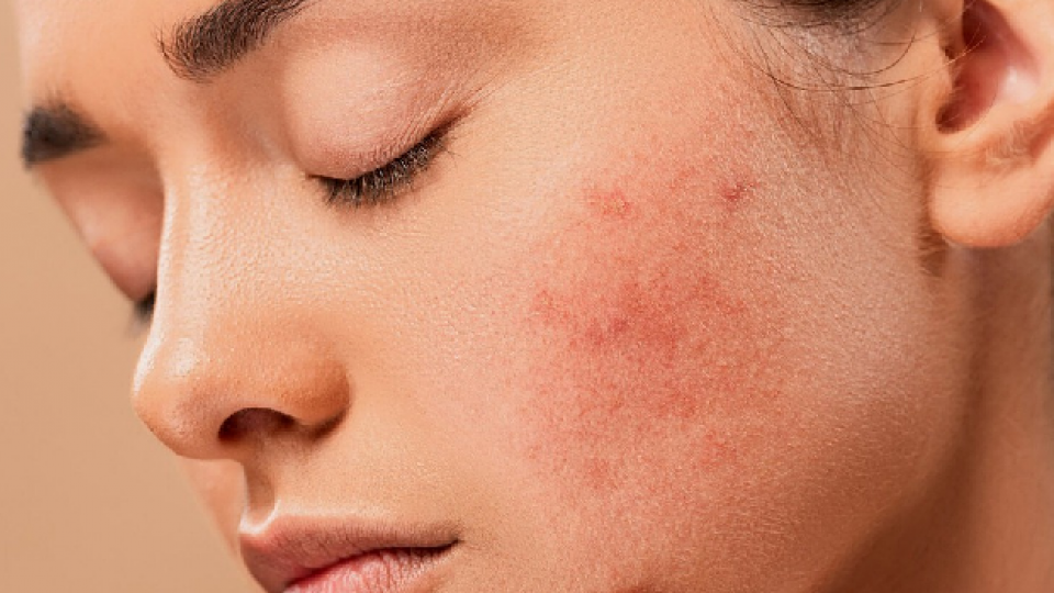 Cos'è L'acne? E come si può curare?